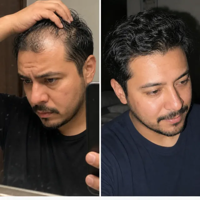 Scalp of Ricardo before starting the routine and after 5 months