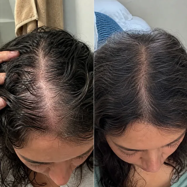 Scalp of Valeria before starting the routine and after 4 months