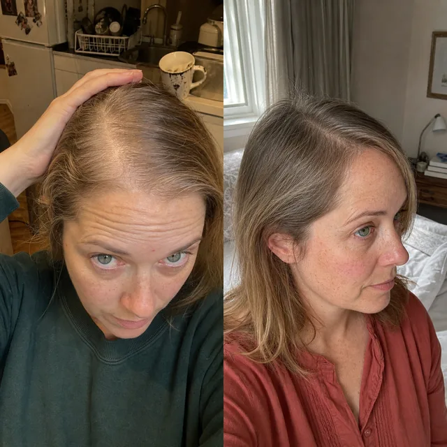 Scalp of Livia Andrade before starting the routine and after 9 months