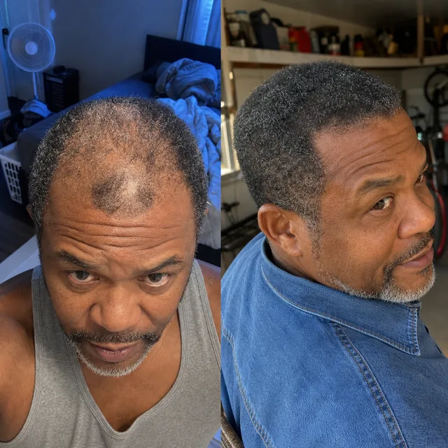 Scalp of Rufus Baptiste before starting the routine and after 5 months