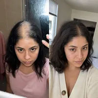Scalp of Aurelia Moreno before starting the routine and after 4 months