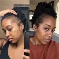 Scalp of Cassia Nascimento before starting the routine and after 6 months