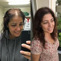 Scalp of Flavia Rojas before starting the routine and after 7 months