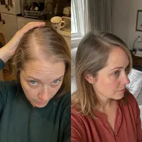 Scalp of Livia Andrade before starting the routine and after 9 months