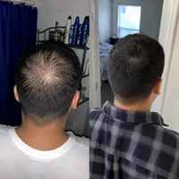 Scalp of Lucius Herrera before starting the routine and after 5 months