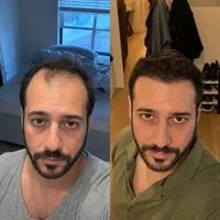 Scalp of Marcus Batista before starting the routine and after 4 months