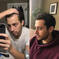 Scalp of Octavia Solís before starting the routine and after 6 months